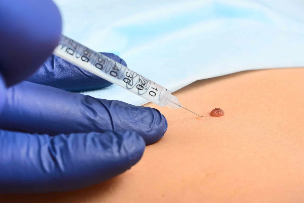 local anesthesia mole b56769a7261945d2ba813c91f24767e2